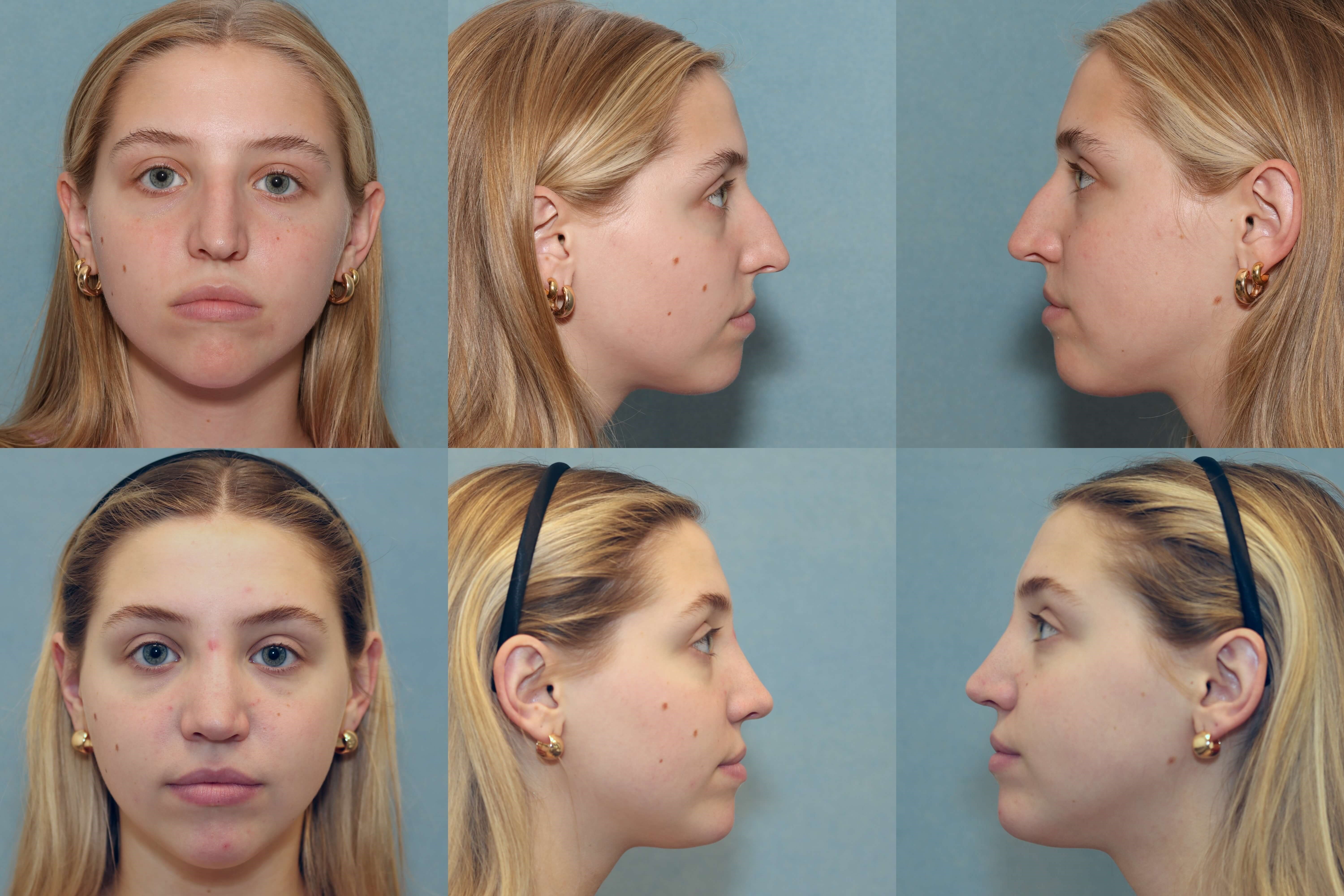 Primary Rhinoplasty Top-Before; Lower-After